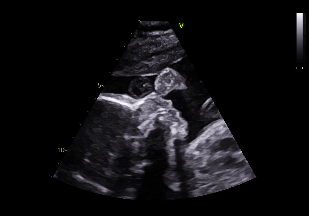 Imagem de ecocardiograma fetal mostrando estruturas do coração do bebê
