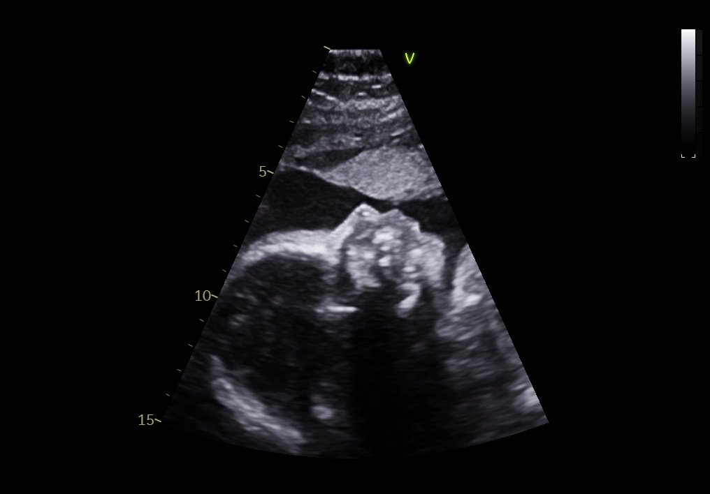 Imagem de ecocardiograma fetal em outro corte anatômico