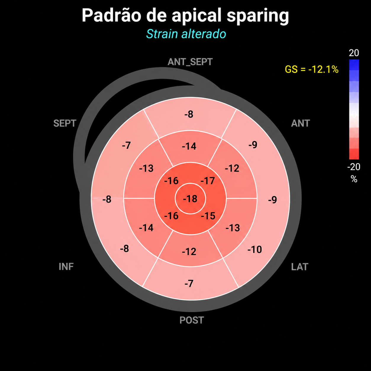 Mapa de strain com padrão de preservação apical, apical sparing